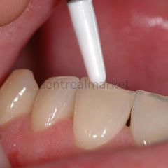 A-Dapt Estetik Silikon Kompozit Şekillendirme Aleti Set