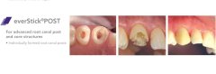 EverStick Post İntro Set